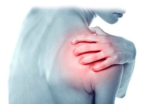 Síndrome de dolor un síntoma de inflamación de las articulaciones. 