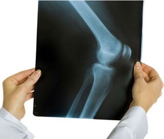 Radiografía de artrosis de rodilla