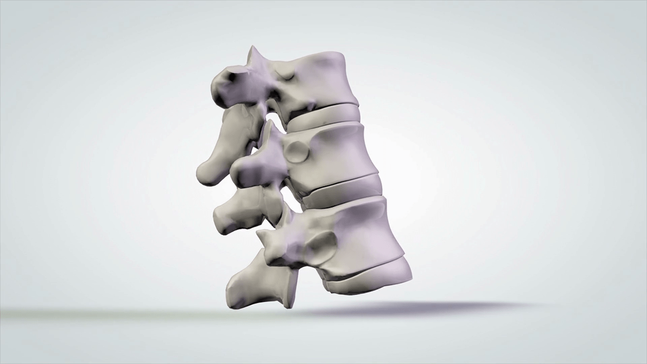 lesión espinal en la osteocondrosis cervical